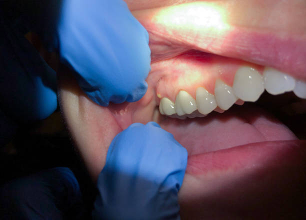 Best Emergency Wisdom Tooth Extraction in Fairview, NC
